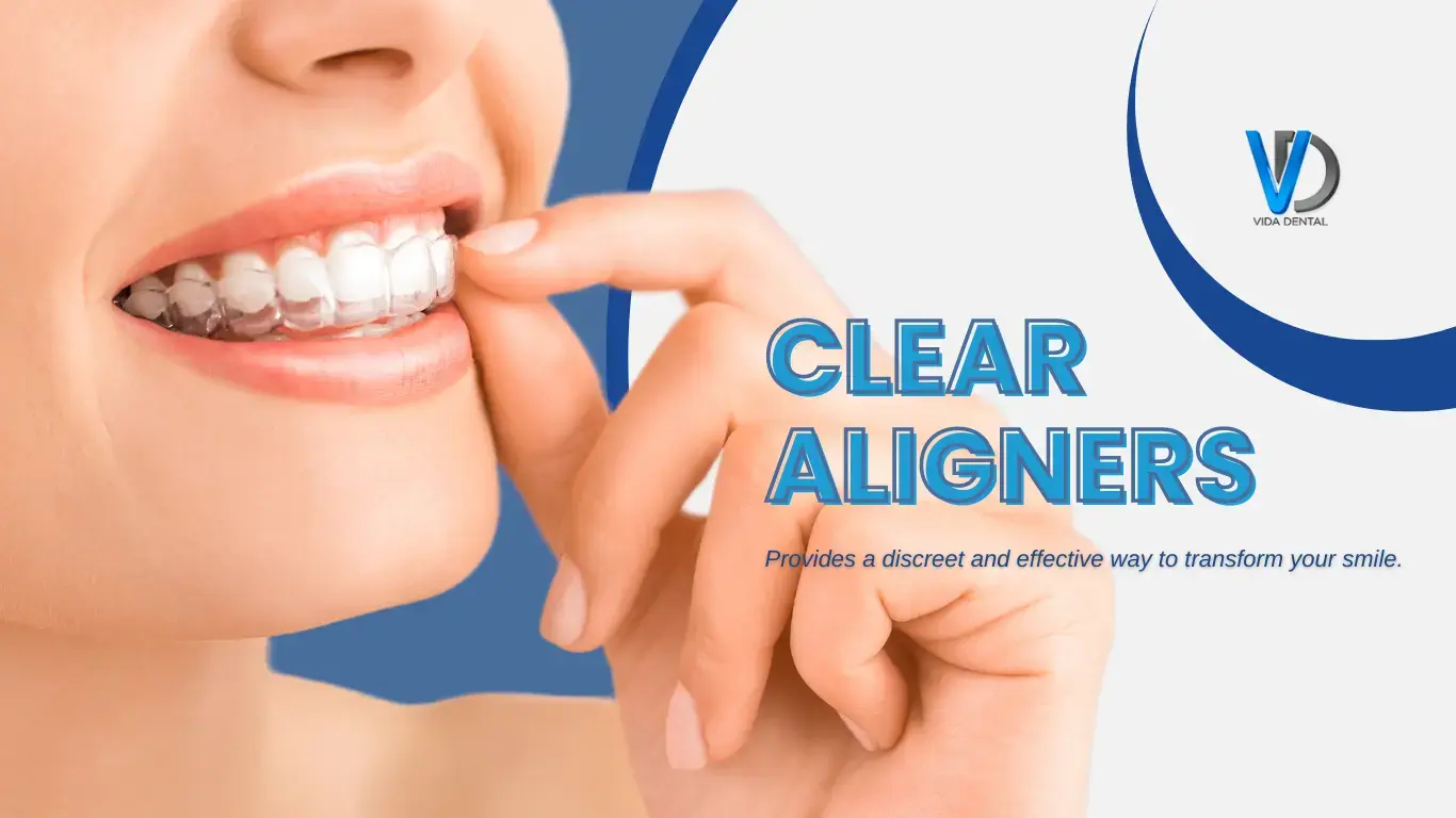 Vida Dental Clear Aligners