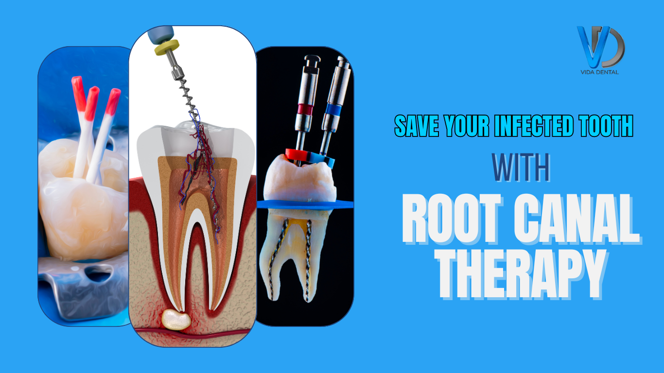 Vida dental-Root Canal