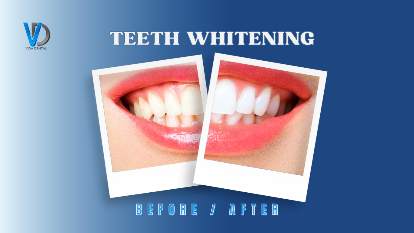 Vida dental-Teeth Whitening1