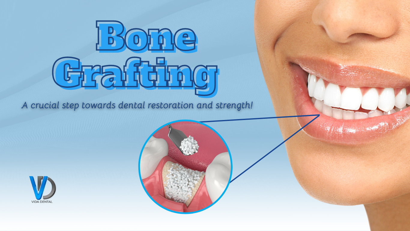 Vida dental-Bone grafting