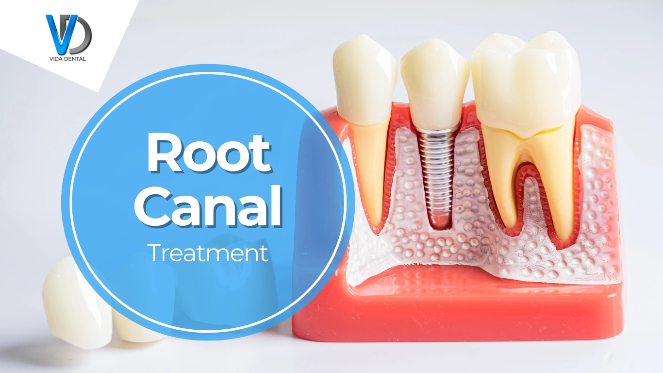 Vida Dental-Root canal