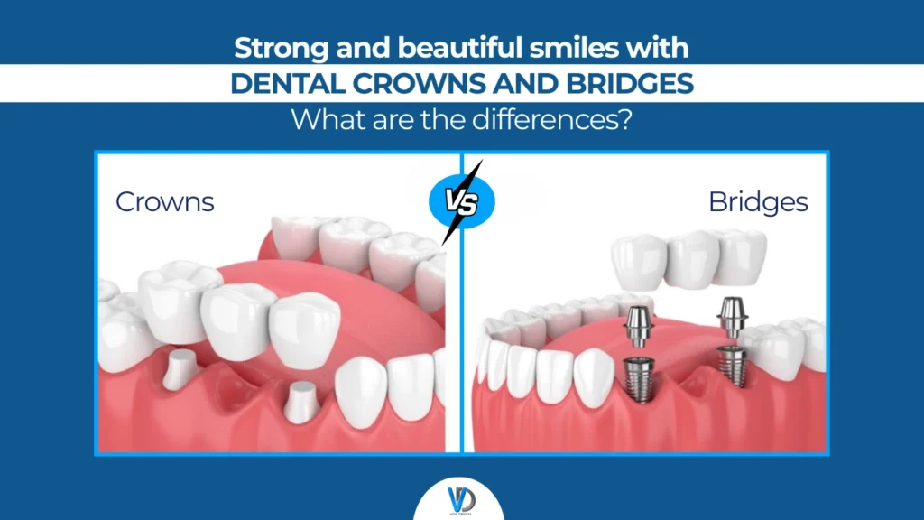 Dental Crowns and Bridges