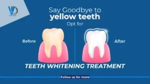 Vida Dental_Teeth Whitening