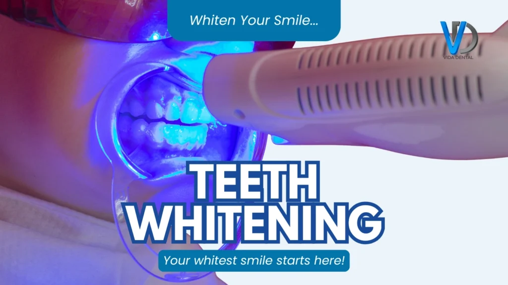 Why Professional Teeth Whitening Is the Go-To Smile Upgrade