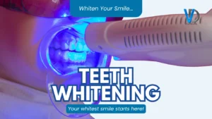 Why Professional Teeth Whitening Is the Go-To Smile Upgrade